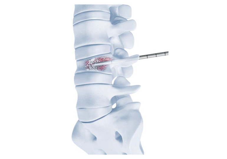 Vertebroplastica tempi recupero